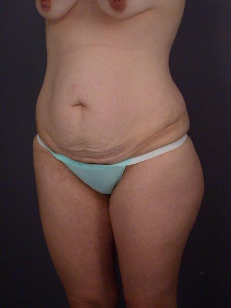 Liposuction Before & After Image