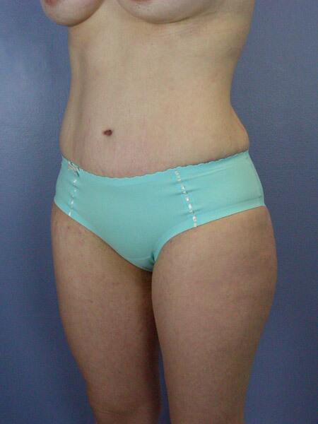 Liposuction Before & After Image