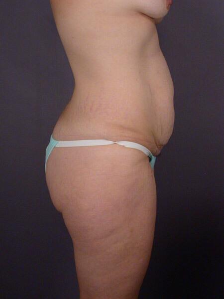 Liposuction Before & After Image