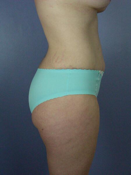 Liposuction Before & After Image