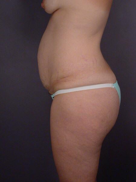 Liposuction Before & After Image