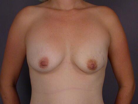 Liposuction Before & After Image