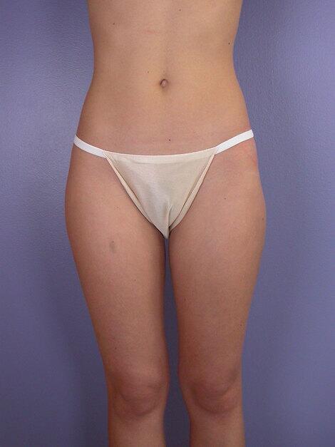 Liposuction Before & After Image