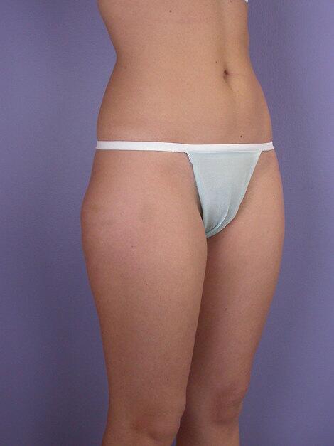 Liposuction Before & After Image