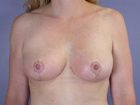 Liposuction Before & After Image