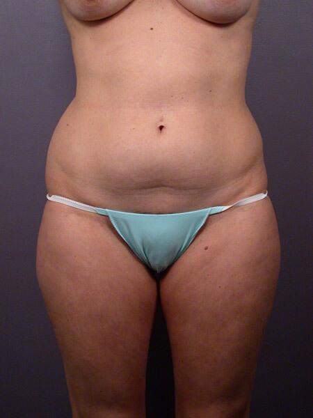 Liposuction Before & After Image