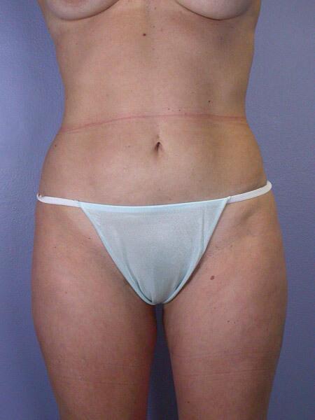 Liposuction Before & After Image