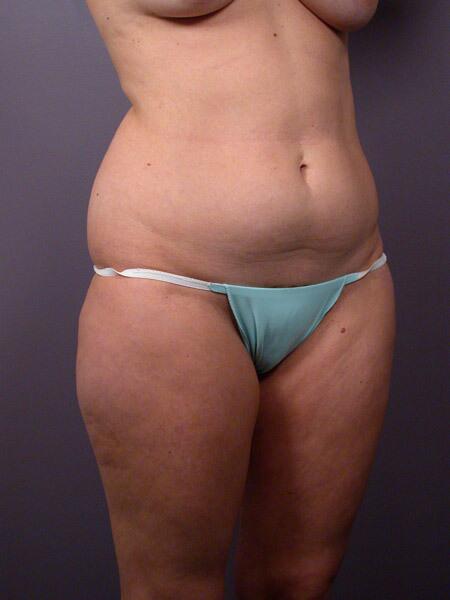 Liposuction Before & After Image