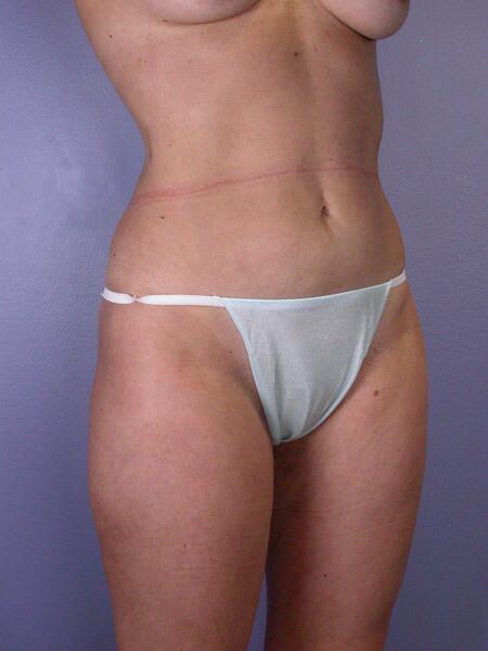 Liposuction Before & After Image