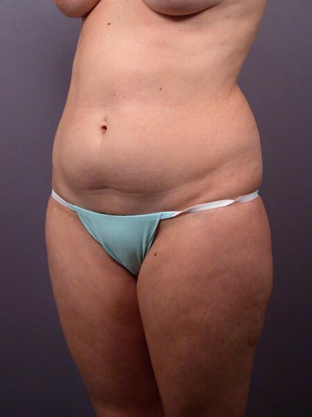 Liposuction Before & After Image