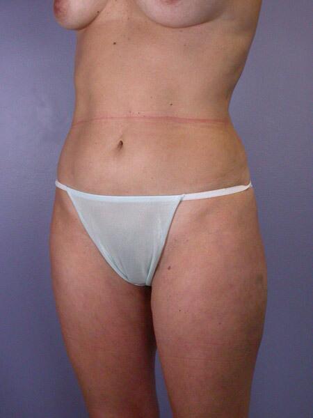 Liposuction Before & After Image