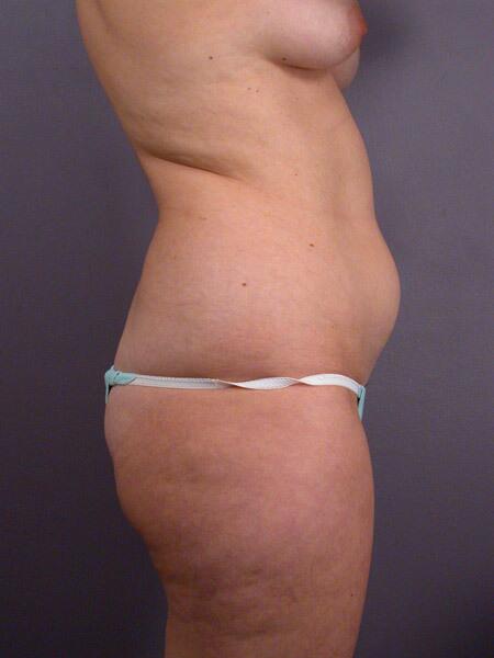 Liposuction Before & After Image