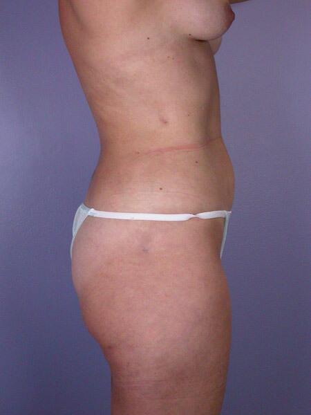 Liposuction Before & After Image