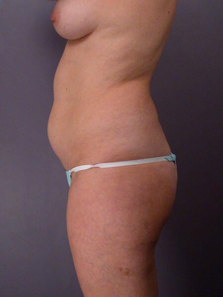 Liposuction Before & After Image