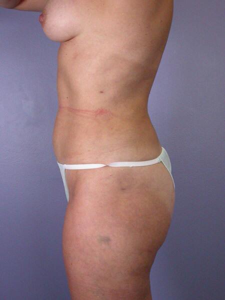 Liposuction Before & After Image