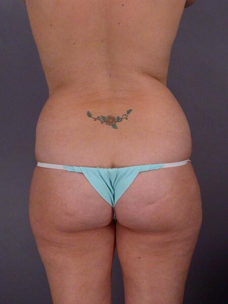 Liposuction Before & After Image