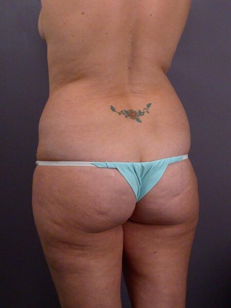 Liposuction Before & After Image