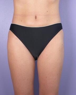 Liposuction Before & After Image