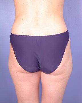 Liposuction Before & After Image