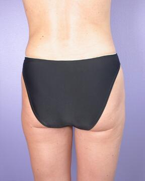 Liposuction Before & After Image