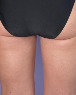 Liposuction Before & After Image