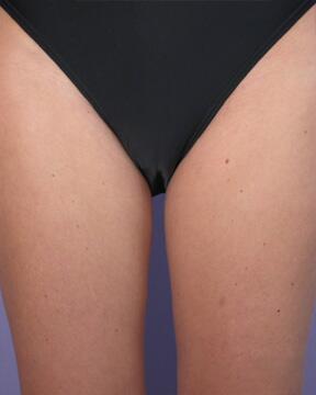 Liposuction Before & After Image