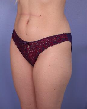 Liposuction Before & After Image