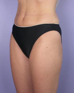 Liposuction Before & After Image