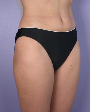 Liposuction Before & After Image