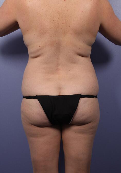 Liposuction Before & After Image