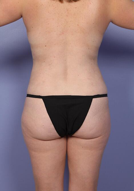 Liposuction Before & After Image