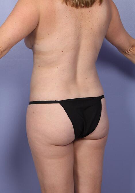 Liposuction Before & After Image