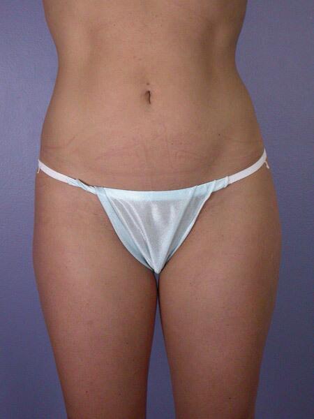 Liposuction Before & After Image