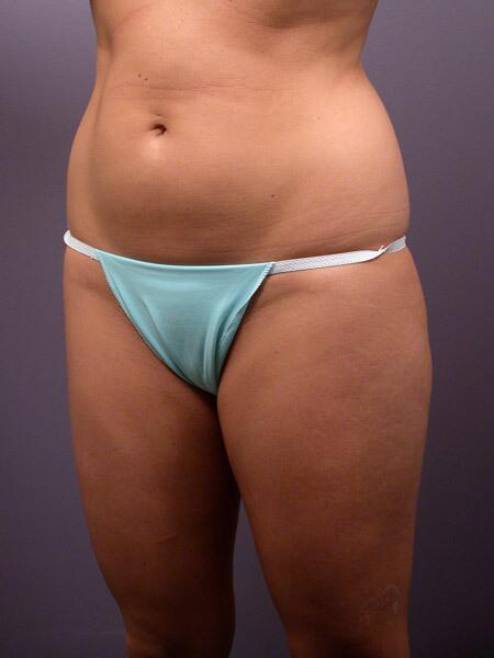 Liposuction Before & After Image