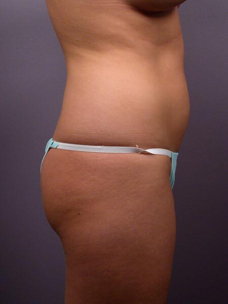 Liposuction Before & After Image