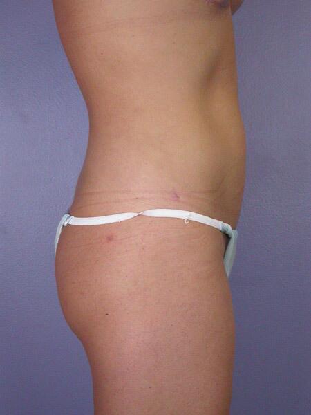 Liposuction Before & After Image