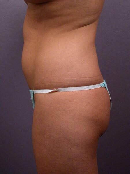 Liposuction Before & After Image