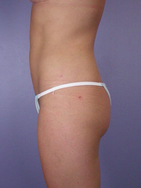 Liposuction Before & After Image