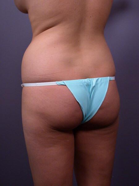 Liposuction Before & After Image