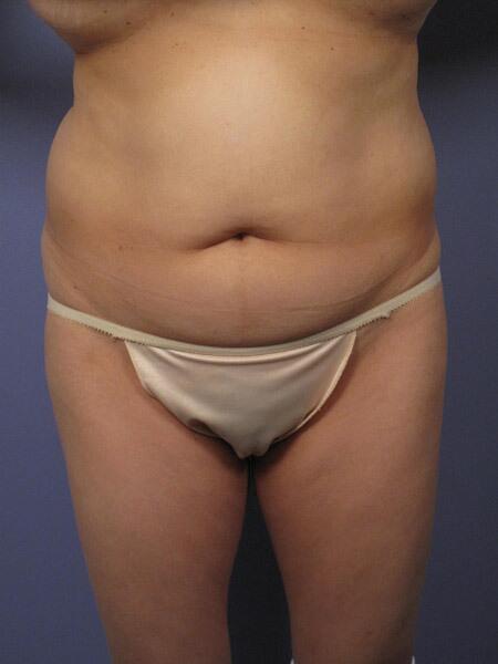 Liposuction Before & After Image