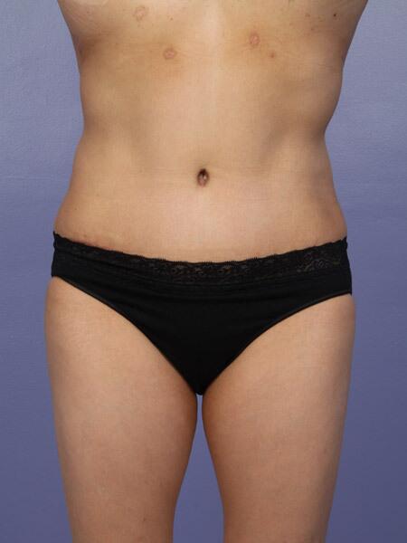 Liposuction Before & After Image