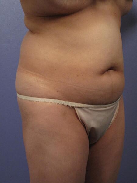 Liposuction Before & After Image