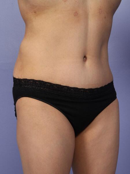 Liposuction Before & After Image