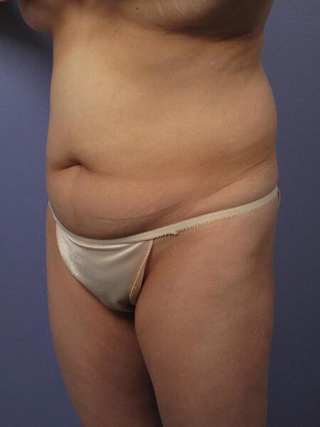 Liposuction Before & After Image