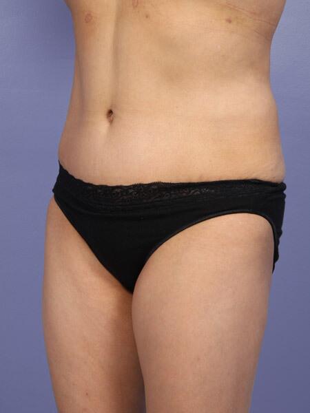 Liposuction Before & After Image