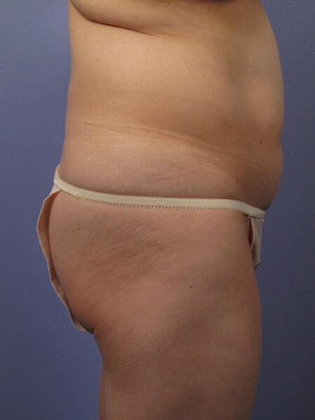 Liposuction Before & After Image