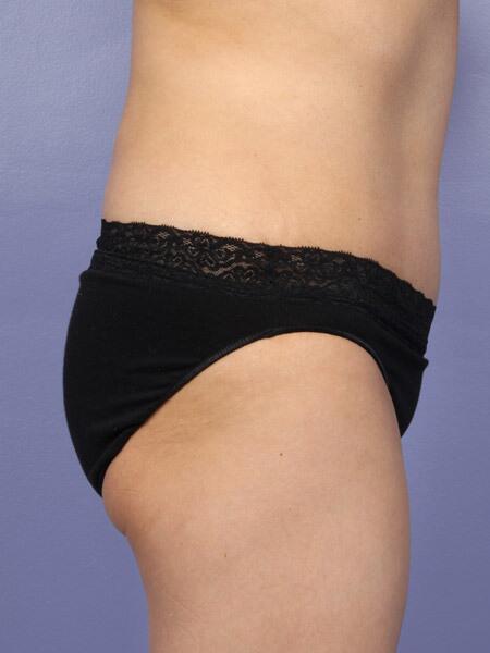 Liposuction Before & After Image