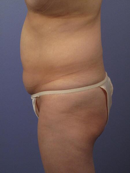 Liposuction Before & After Image