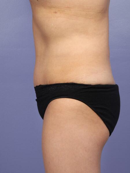 Liposuction Before & After Image