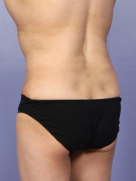 Liposuction Before & After Image